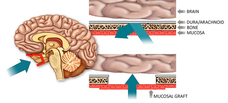 Illustrated concept of delivery method for drugs used to treat a variety of central nervous system diseases. 